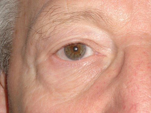 rechtes Auge nach der Operation
