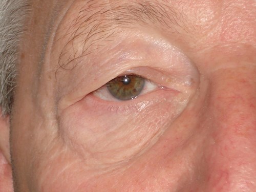 rechtes Auge vor der Operation